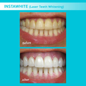teeth-whitening