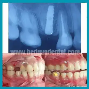 Dental Implant - Before & After photos