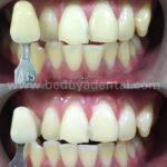instawhite chemical whitening