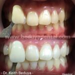instawhite chemical whitening