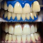 instawhite chemical whitening