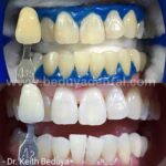instawhite chemical whitening