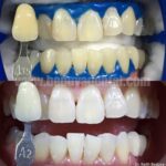instawhite chemical whitening