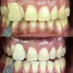 instawhite chemical whitening