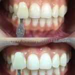 instawhite chemical whitening
