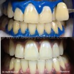 instawhite chemical whitening