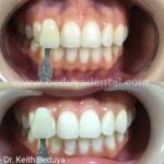 instawhite chemical whitening