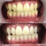 instawhite chemical whitening