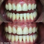 non-surgical smile make-over