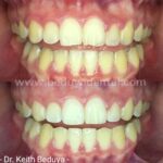 non-surgical smile make-over