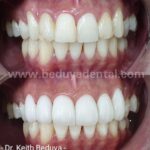 Porcelain Veneers