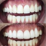 Porcelain Veneers