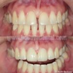 Porcelain Veneers