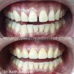Porcelain Veneers