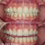 Porcelain Veneers