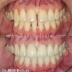 Porcelain Veneers