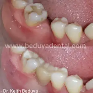 Fibrabridge - Before & After photos