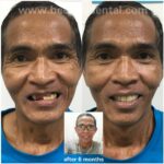 Non-surgical Face Contouring