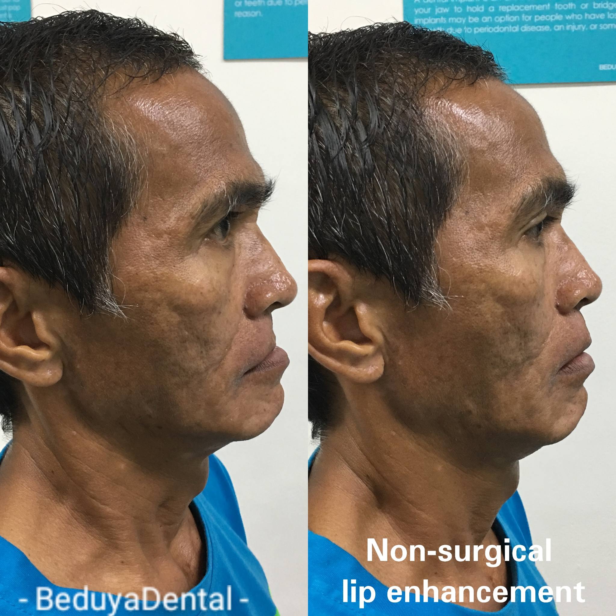 Non-surgical Face Contouring