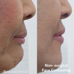 Non-surgical Face Contouring