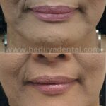 Non-surgical Face Contouring