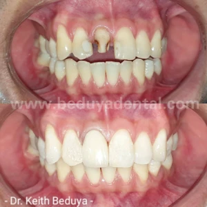 Porcelain Fused to Metal Crown - Before & After photos