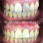 Porcelain Fused to Metal Crown