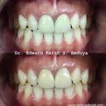 Porcelain Fused to Metal Crown