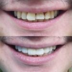 beduya porcelain veneers1