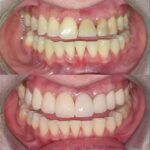 beduya porcelain veneers2