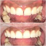 Camouflage (for front teeth)