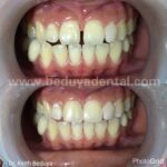 Camouflage (for front teeth)