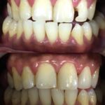 Camouflage (for front teeth)