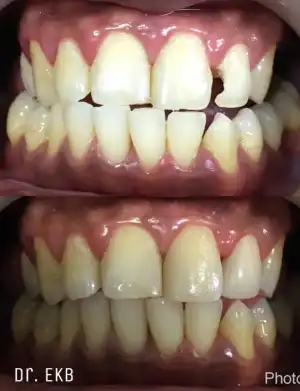 Camouflage (for front teeth) - Before & After photos
