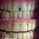 Camouflage (for front teeth)