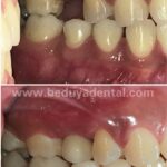 Dental Implant