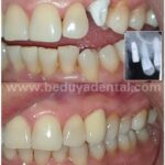 Dental Implant