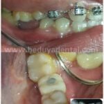Dental Implant