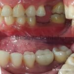 Dental Implant