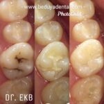 Dura (for back teeth)