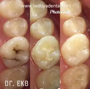 Dura (for back teeth) - Before & After photos
