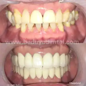 Full Mouth Crowns - Before & After photos
