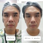 masseter hypertrophy2