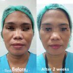 masseter hypertrophy3