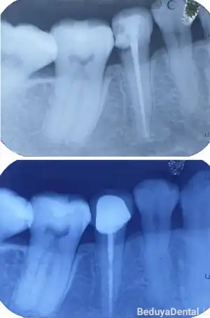 Post and Crown - Before & After photos