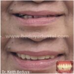 Removable Denture