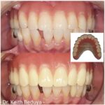 Removable Denture