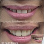 Removable Denture