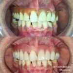 Removable Denture