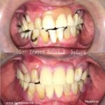 Removable Denture